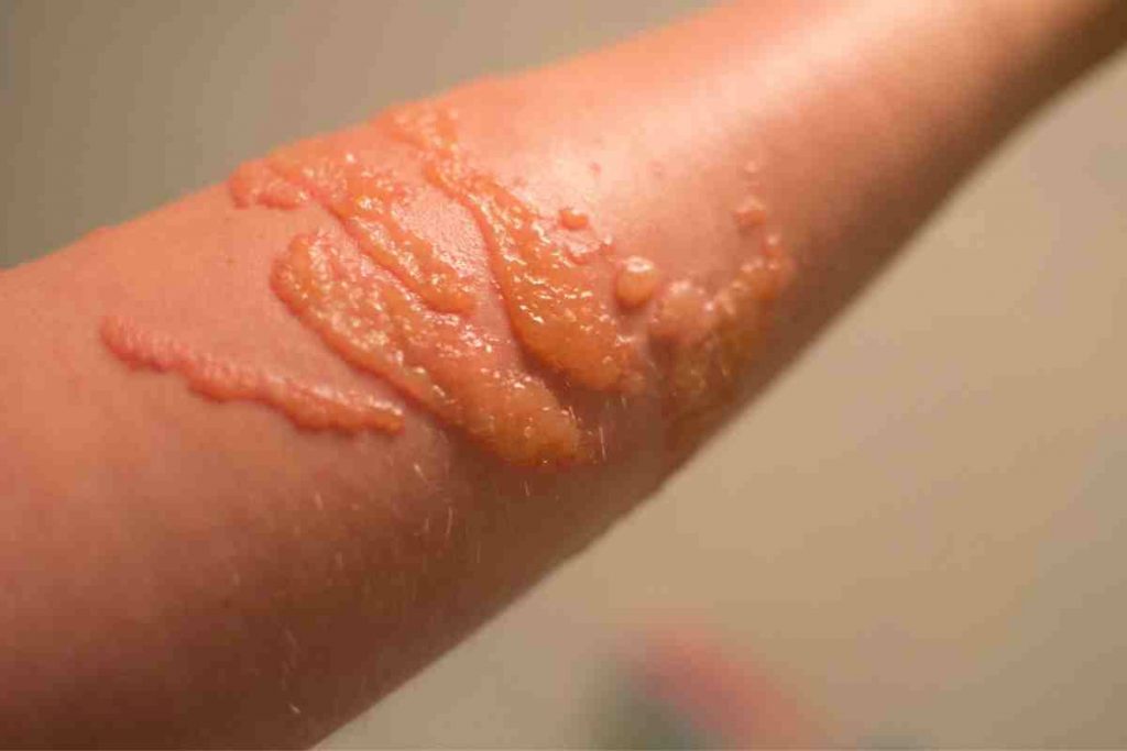 Puntura di medusa, ecco cosa fare i rimedi e gli errori da non